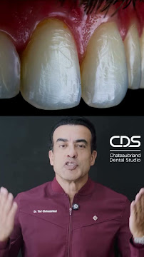 CDS Odontologia Digital - Lente de contato dental em Tatuapé - Lente de porcelana em Tatuapé - Protocolo Fixo
