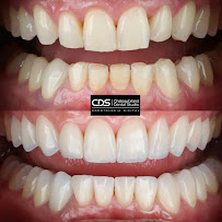 CDS Odontologia Digital - Lente de contato dental em Tatuapé - Lente de porcelana em Tatuapé - Protocolo Fixo