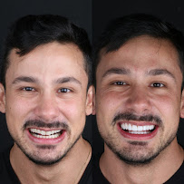 CDS Odontologia Digital - Lente de contato dental em Tatuapé - Lente de porcelana em Tatuapé - Protocolo Fixo