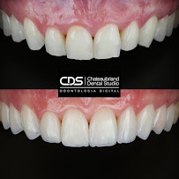 CDS Odontologia Digital - Lente de contato dental em Tatuapé - Lente de porcelana em Tatuapé - Protocolo Fixo