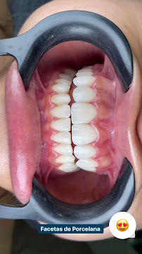 Odonto Liuzzi | Lentes de Contato Dental | Prótese Protocolo | Ortodontia | Periodontia | Implante Dentário | Dental Tourism