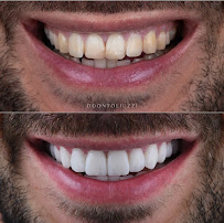 Odonto Liuzzi | Lentes de Contato Dental | Prótese Protocolo | Ortodontia | Periodontia | Implante Dentário | Dental Tourism