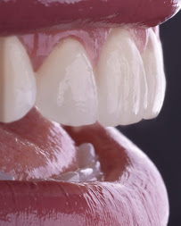 Odonto Liuzzi | Lentes de Contato Dental | Prótese Protocolo | Ortodontia | Periodontia | Implante Dentário | Dental Tourism
