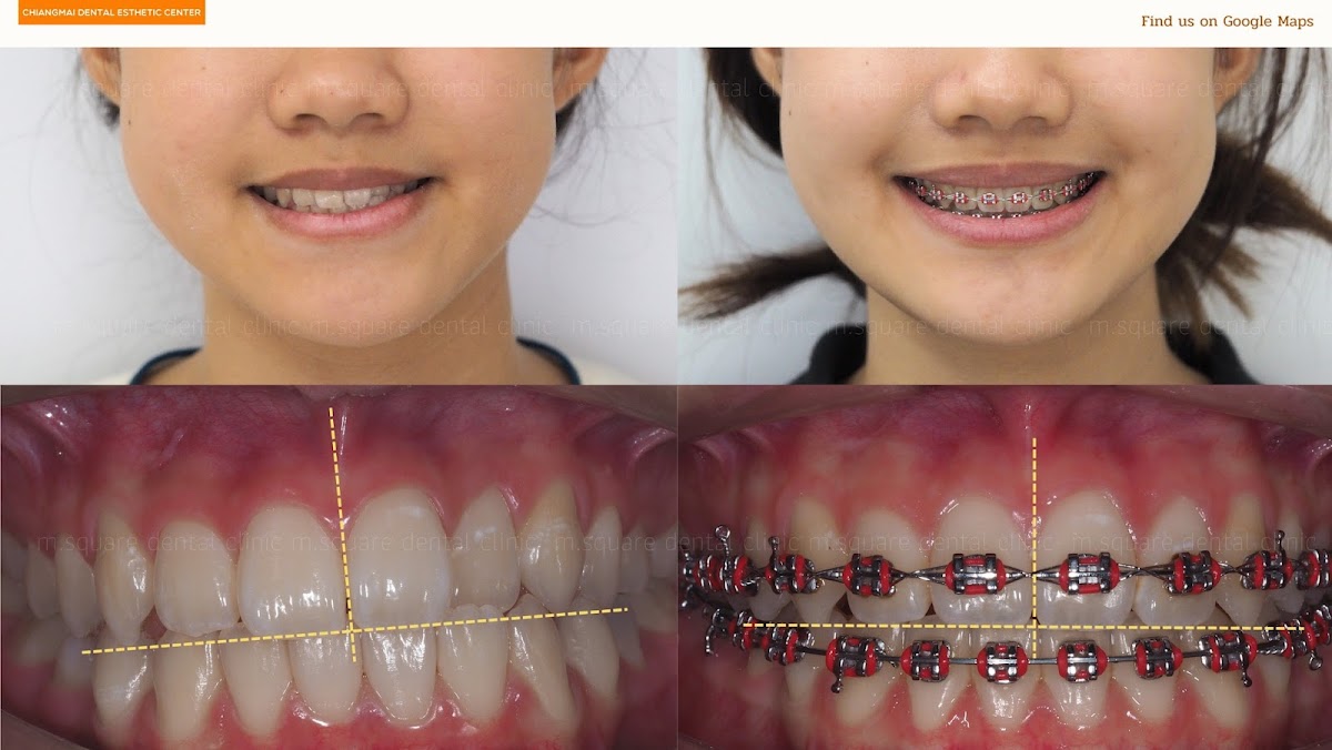 Dental Clinic ทำฟัน จัดฟัน เชียงใหม่ M.square dental clinic in Chiang Mai