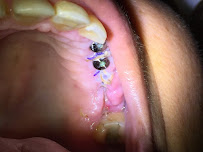 Dental Implants Costa Rica - Dr. Jairo Vargas Clinic