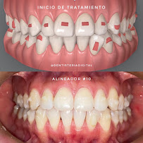 DENTISTERÍA DIGITAL - ORTODONCIA INVISIBLE - INVISALIGN - SMARTEE