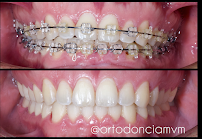 Ortodoncia MVM - Medicina Dental - Ortodoncia - Diseño de sonrisa - Alineadores