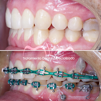 Ortodoncia MVM - Medicina Dental - Ortodoncia - Diseño de sonrisa - Alineadores