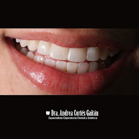 Diseño de sonrisa | Carillas | Dra Andrea Cortes Gaitán | Odontologo | Bogotá