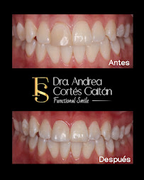 Diseño de sonrisa | Carillas | Dra Andrea Cortes Gaitán | Odontologo | Bogotá