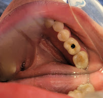 Dr Carlos Castro Rehabilitador Oral Bogotá Implantes dentales