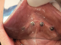 Dr Carlos Castro Rehabilitador Oral Bogotá Implantes dentales