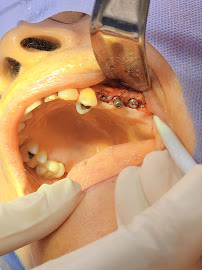 Dr Carlos Castro Rehabilitador Oral Bogotá Implantes dentales