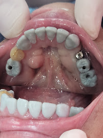 Dr Carlos Castro Rehabilitador Oral Bogotá Implantes dentales
