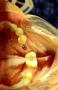 Dr Carlos Castro Rehabilitador Oral Bogotá Implantes dentales
