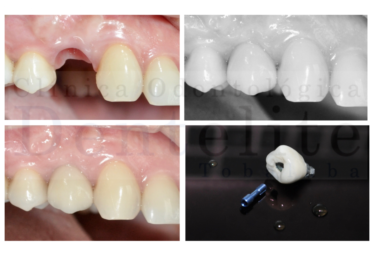 CLINICA DENTELITE Implantes Dentales Dentistas en Providencia Santiago - dental clinic in Santiago, Chile