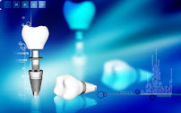 CLINICA DENTELITE Implantes Dentales Dentistas en Providencia Santiago
