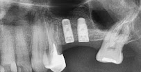 CLINICA DENTELITE Implantes Dentales Dentistas en Providencia Santiago