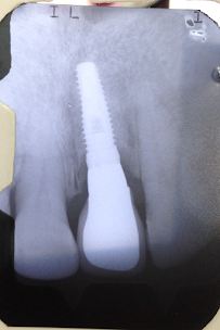CLINICA DENTELITE Implantes Dentales Dentistas en Providencia Santiago