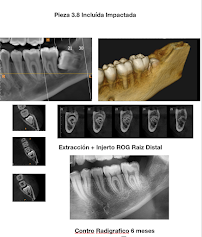 CLINICA DENTELITE Implantes Dentales Dentistas en Providencia Santiago