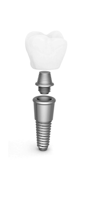 CLINICA DENTELITE Implantes Dentales Dentistas en Providencia Santiago