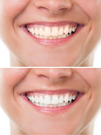 CLINICA DENTELITE Implantes Dentales Dentistas en Providencia Santiago