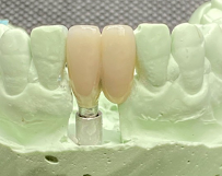 CLINICA DENTELITE Implantes Dentales Dentistas en Providencia Santiago
