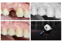 CLINICA DENTELITE Implantes Dentales Dentistas en Providencia Santiago in Santiago, Chile