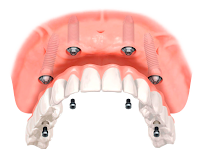 IMPLANOR Implantes Dentales Antofagasta