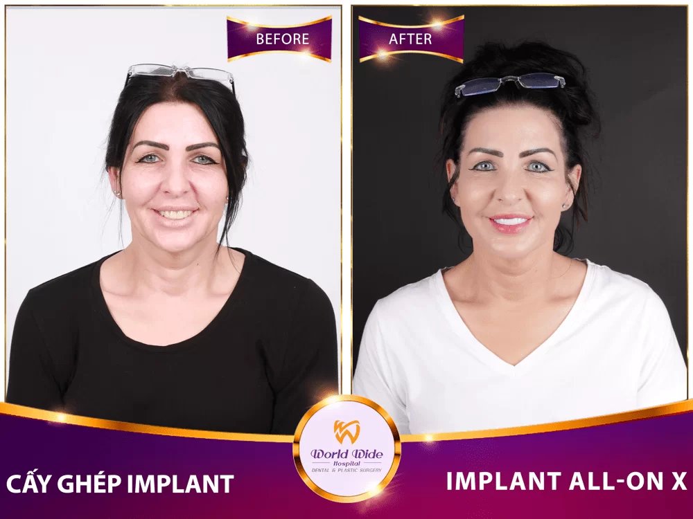Before/after dental result at Worldwide Beauty And Dental Hospital