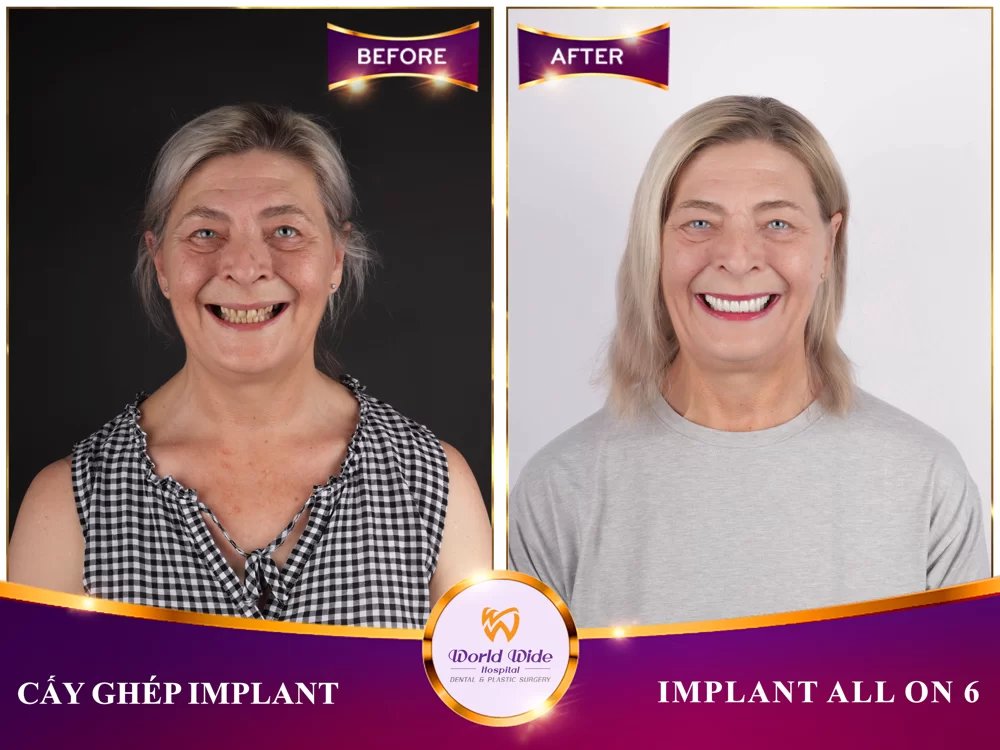 Before/after dental result at Worldwide Beauty And Dental Hospital