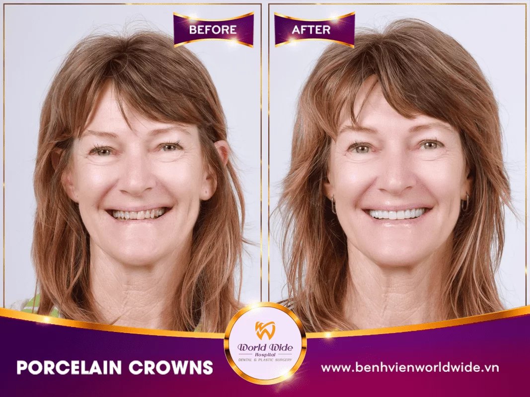 Before/after dental result at Worldwide Beauty And Dental Hospital
