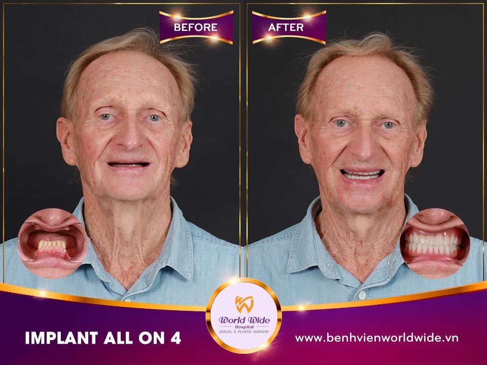 Before/after dental result at Worldwide Beauty And Dental Hospital