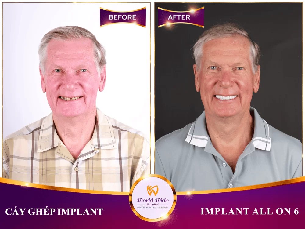 Before/after dental result at Worldwide Beauty And Dental Hospital