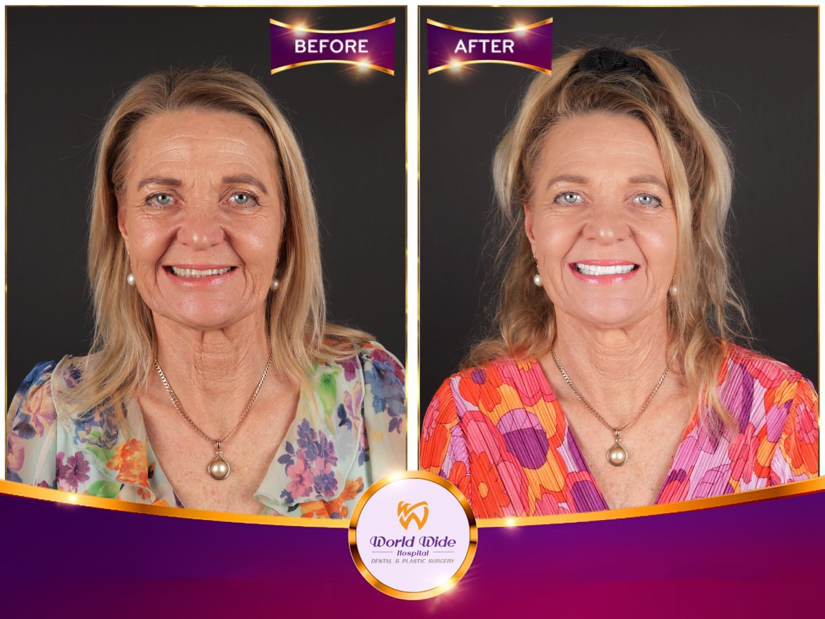 Before/after dental result at Worldwide Beauty And Dental Hospital