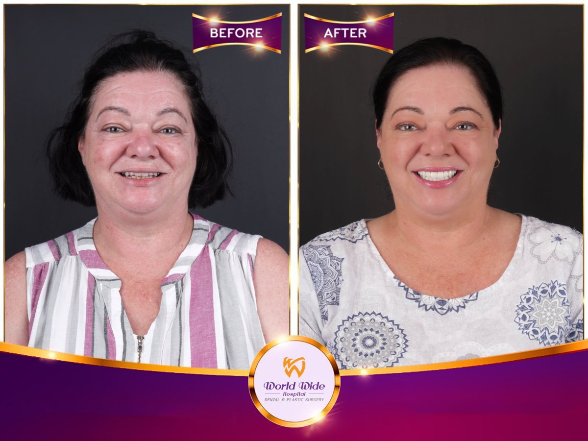 Before/after dental result at Worldwide Beauty And Dental Hospital