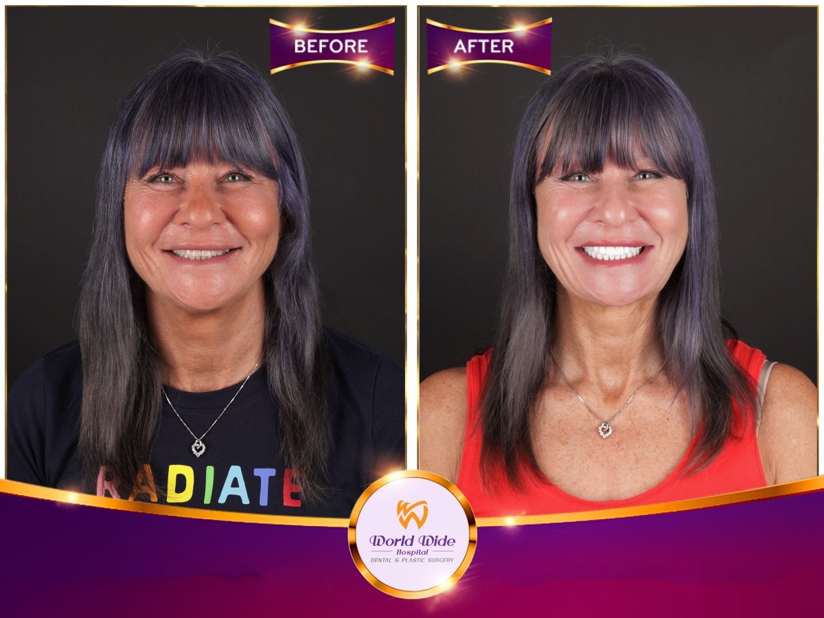 Before/after dental result at Worldwide Beauty And Dental Hospital