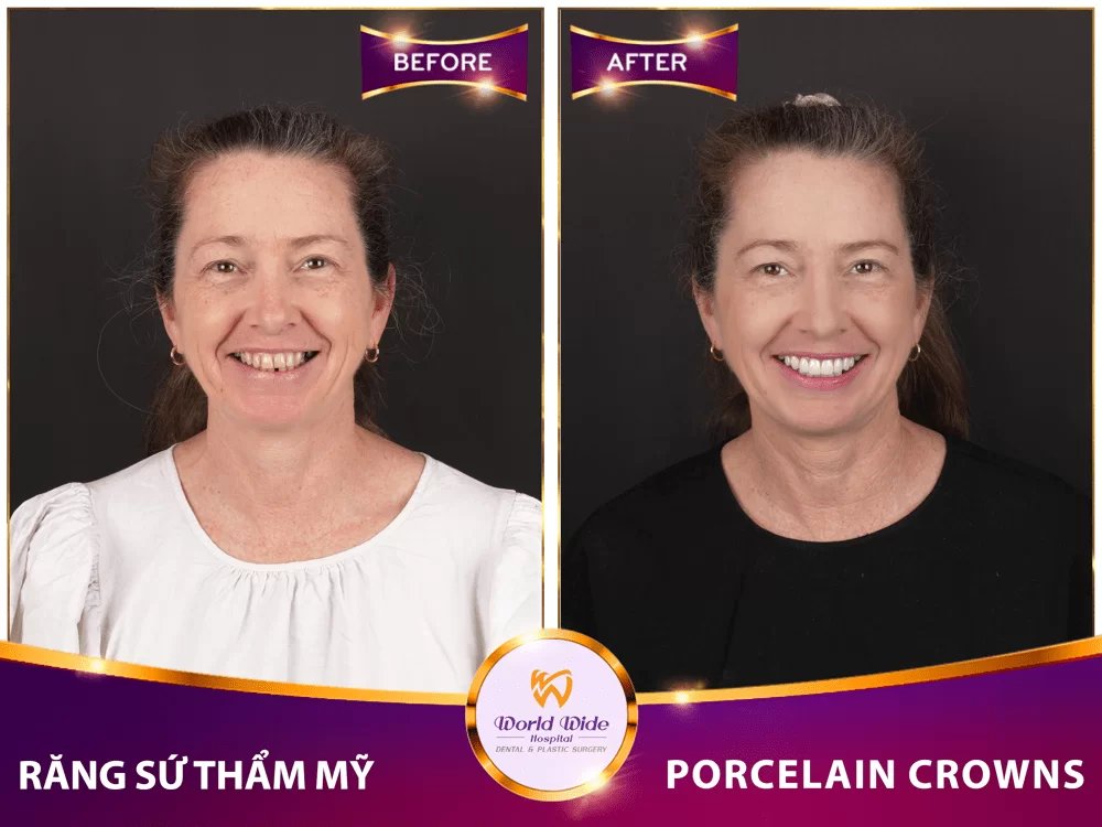 Before/after dental result at Worldwide Beauty And Dental Hospital