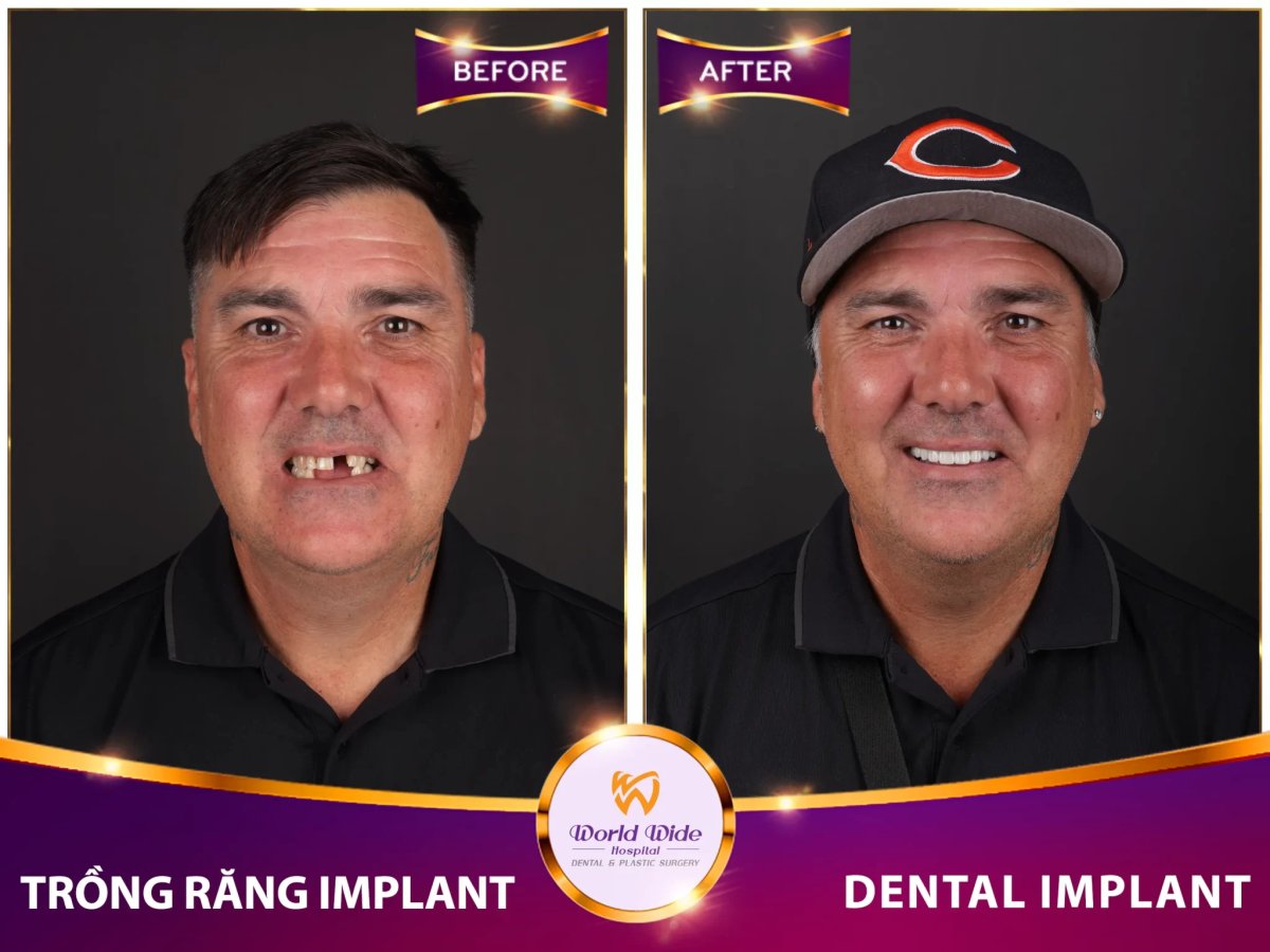 Before/after dental result at Worldwide Beauty And Dental Hospital