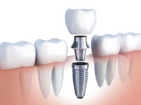 DENTISTA URGENCIAS DENTALES 24 HORAS CLINICA REALDENT CONDESA