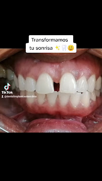 Implant Center Mexico City