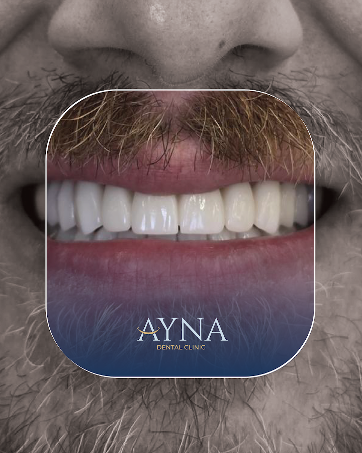 Dentisti in Albania - Clinica Dentale a Tirana - Impianti Dentali - Ortodonzia - Turismo Dentale - Ayna Dental Clinic - dental clinic in Tirana, Albania