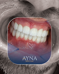 Dentisti in Albania - Clinica Dentale a Tirana - Impianti Dentali - Ortodonzia - Turismo Dentale - Ayna Dental Clinic