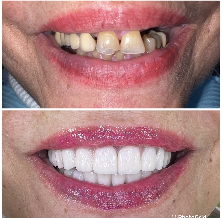 Before/after dental result at Dentisti in Albania-Biodent