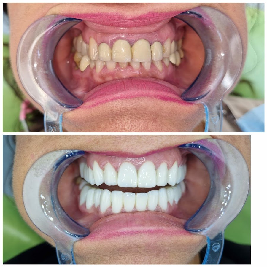 Before/after dental result at Dentisti in Albania-Biodent