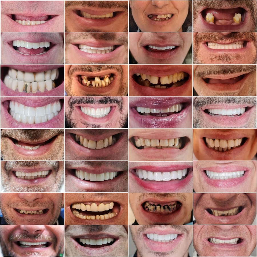 Impianti Dentali Albania - Dentisti in Albania - Oxa Clinic - dental clinic in Tirana, Albania