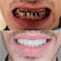 Impianti Dentali Albania - Dentisti in Albania - Oxa Clinic