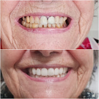 Impianti Dentali Albania - Dentisti in Albania - Oxa Clinic
