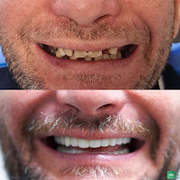 Impianti Dentali Albania - Dentisti in Albania - Oxa Clinic