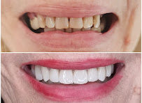 Impianti Dentali Albania - Dentisti in Albania - Oxa Clinic